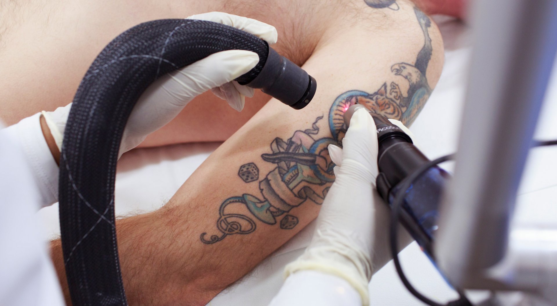 Can pregnancy affect tattoo removal treatment?