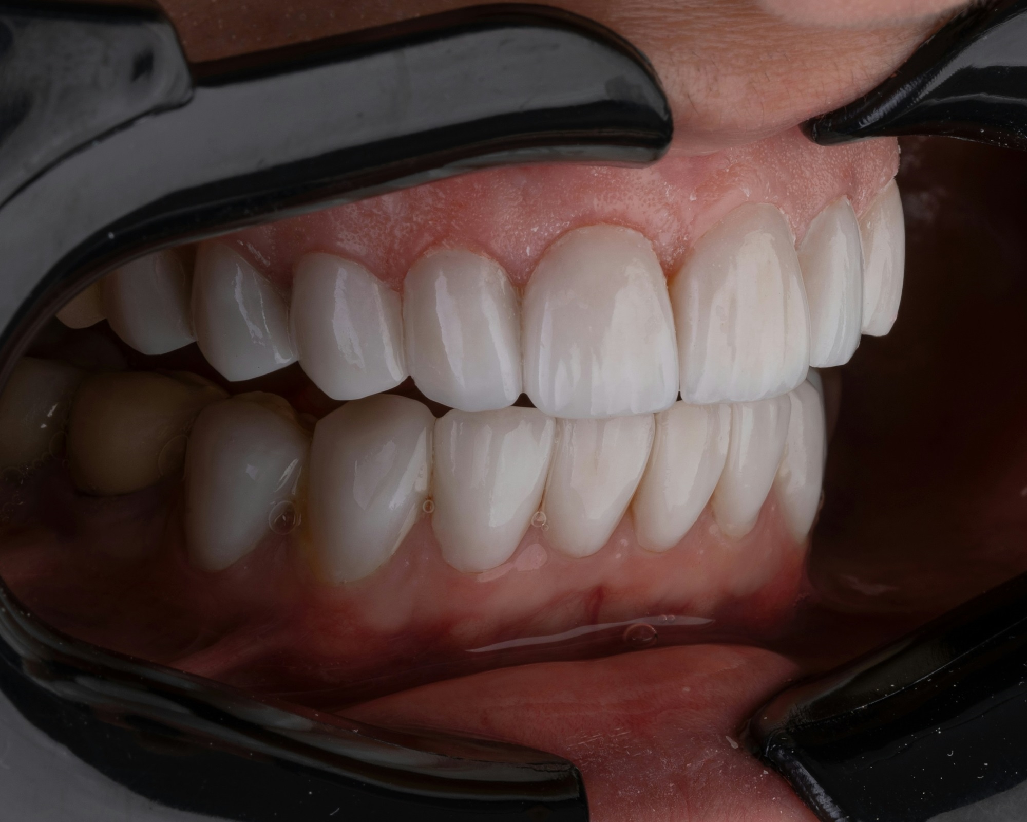 What to Eat After Tooth Extraction & How to Identify a Healthy Blood Clot