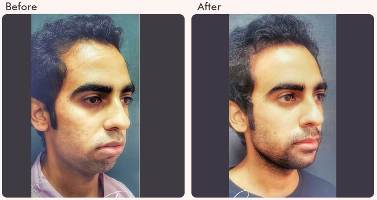 Chin Augmentation Surgery in Delhi - Dr Rajat Gupta