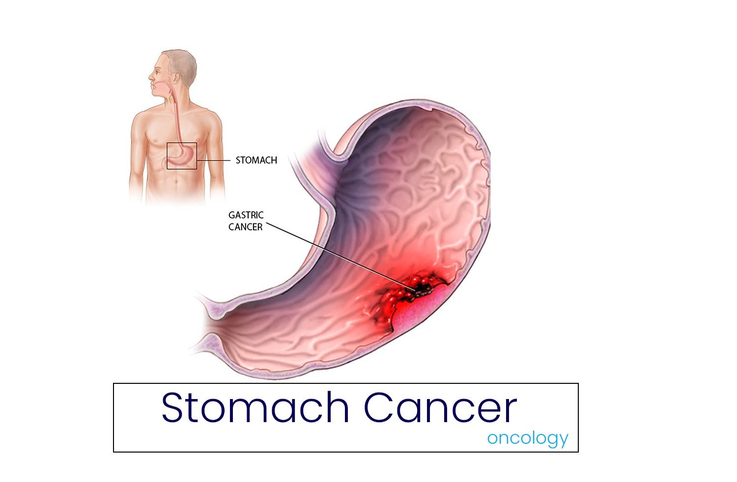 Best GI Cancer Surgeon in Bangalore – Dr. Bhushan Chittawadagi