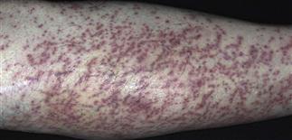 Causes of Asteatotic Eczema: Understanding Dry, Cracked Skin