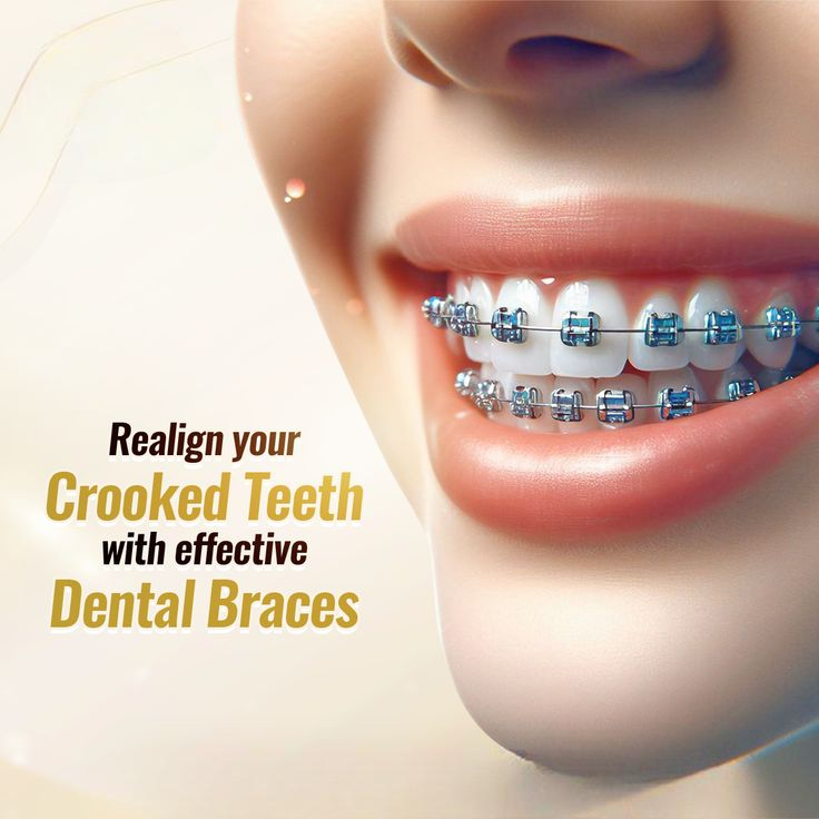Get a Perfectly Aligned Smile with Braces in Islamabad