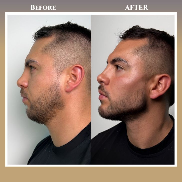 Jaw Alignment Surgery in Islamabad – Correct Jaw Imbalance and Enhance Facial Proportion