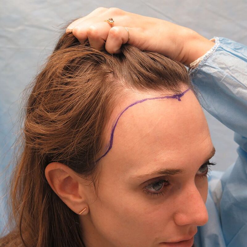 How Do Doctors Assess Candidacy For Female Hair Transplants?