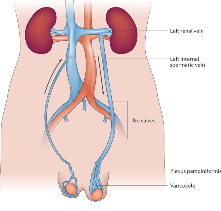 Varicocele Embolisation: A Minimally Invasive Solution