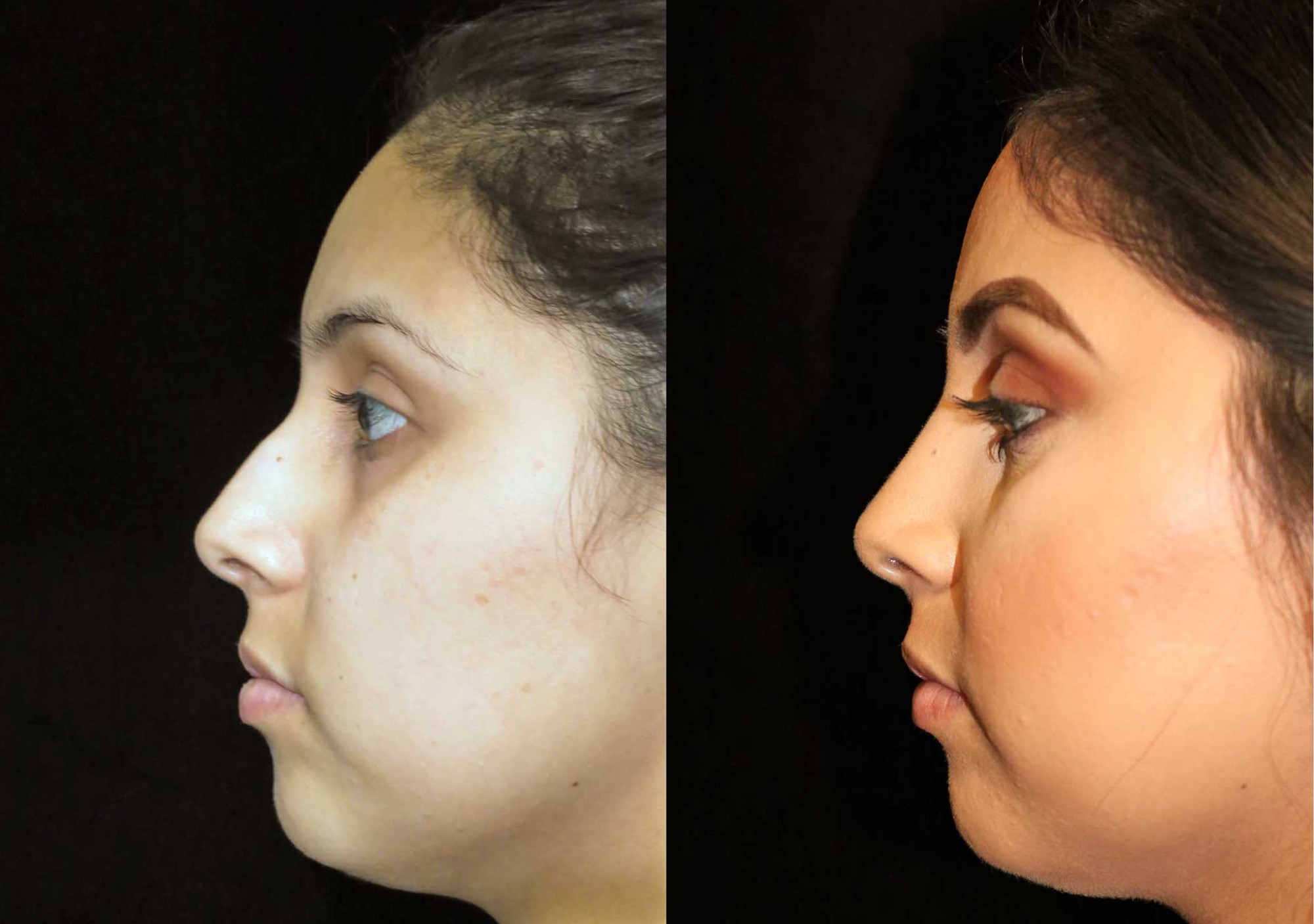 From crookedness to straightness: Before and after rhinoplasty results