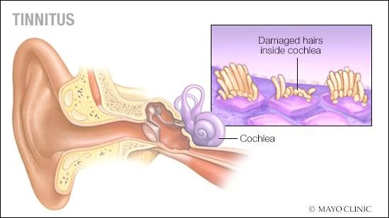 Effective Tinnitus Treatment in Lahore & Test Prices