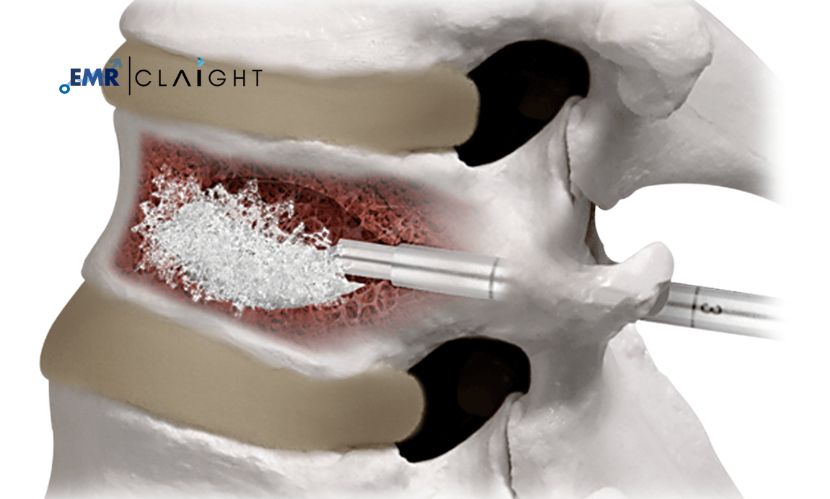 Bone Cement Market Size & Share Report | 2034