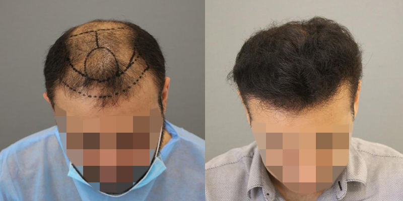 How Hair Transplant in Abu Dhabi Helps Restore Your Self-Esteem
