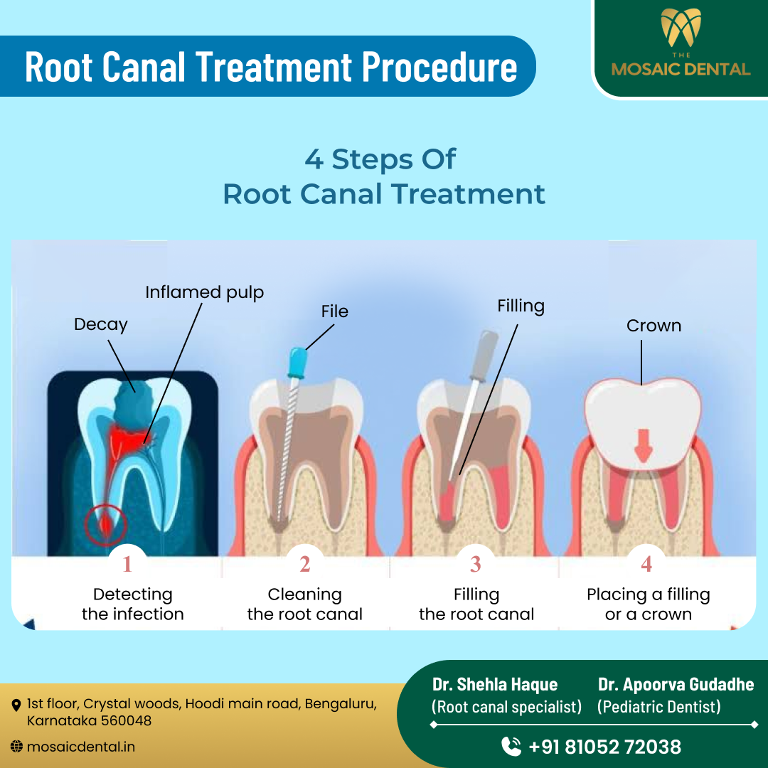 Rediscover Dental Wellness: The Promise of Painless Root Canal Treatment in Bangalore