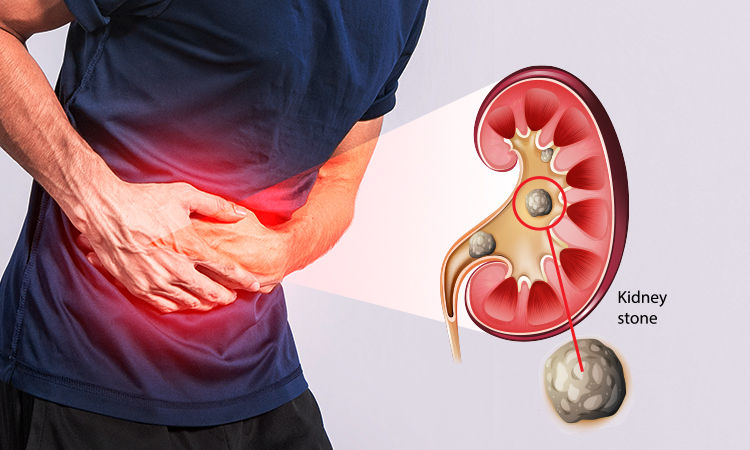 Is Laser Kidney Stone Treatment Painful or Painless?