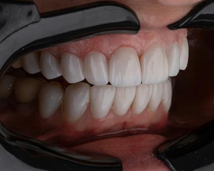What to Eat After Tooth Extraction & How to Identify a Healthy Blood Clot