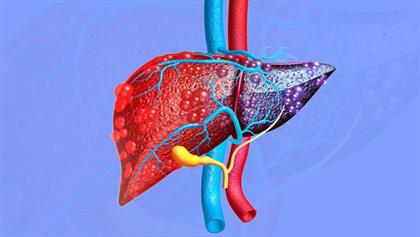 Cirrhosis of the Liver: Symptoms, Causes & Treatments