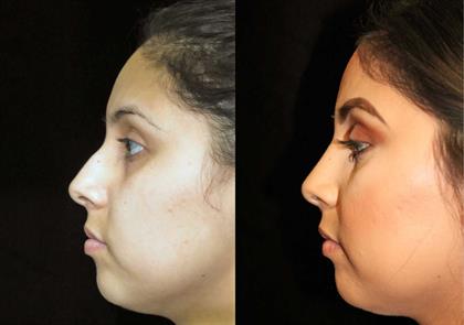 From crookedness to straightness: Before and after rhinoplasty results